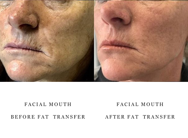 face fat-trans 1